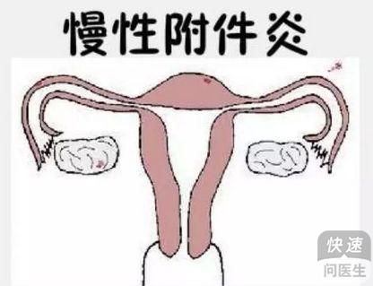 女人附件炎的症状有哪些,女人附件炎的症状解析及实时解答手册,精细解析评估_UHD版24.24.68