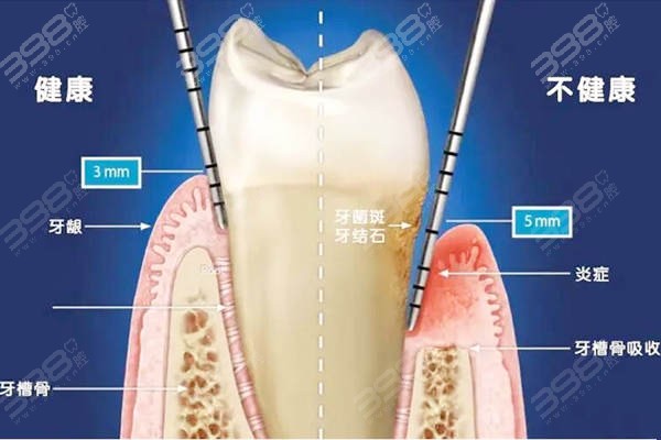 超声波洁牙多少钱一次啊,超声波洁牙的价格及其迅速处理解答问题的重要性,创新性执行策略规划_特供款47.95.46