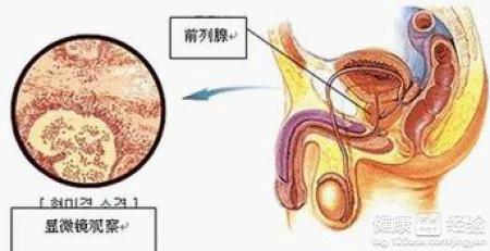 前列腺囊肿如何治疗