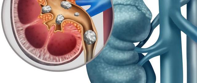 孕期肾结石是什么原因造成的