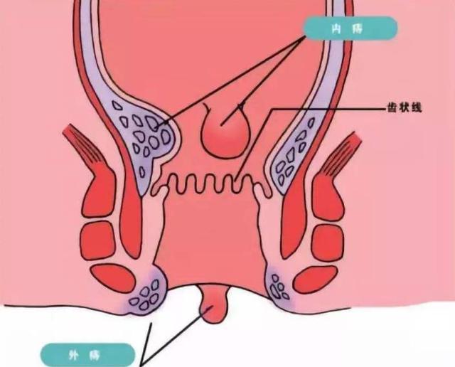 肛门口有个肉球突出是怎么回事还痒,关于肛门口肉球突出及痒感，实地数据执行分析与探讨,专业说明评估_iShop38.92.42
