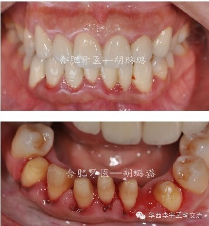 牙体缺损的修复方法有哪些