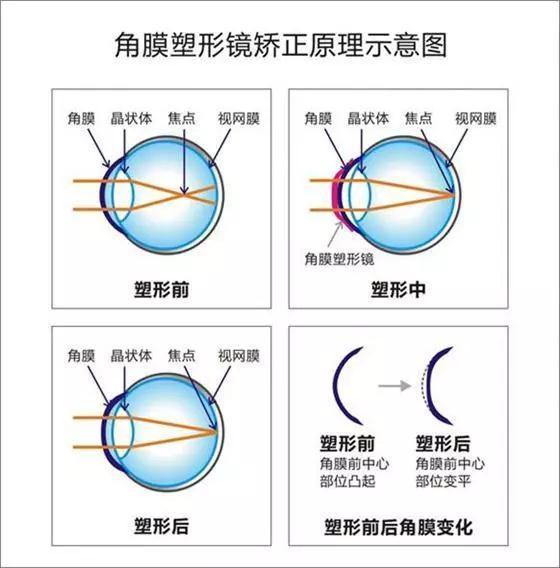 角膜塑形镜的利与弊价格暴跌