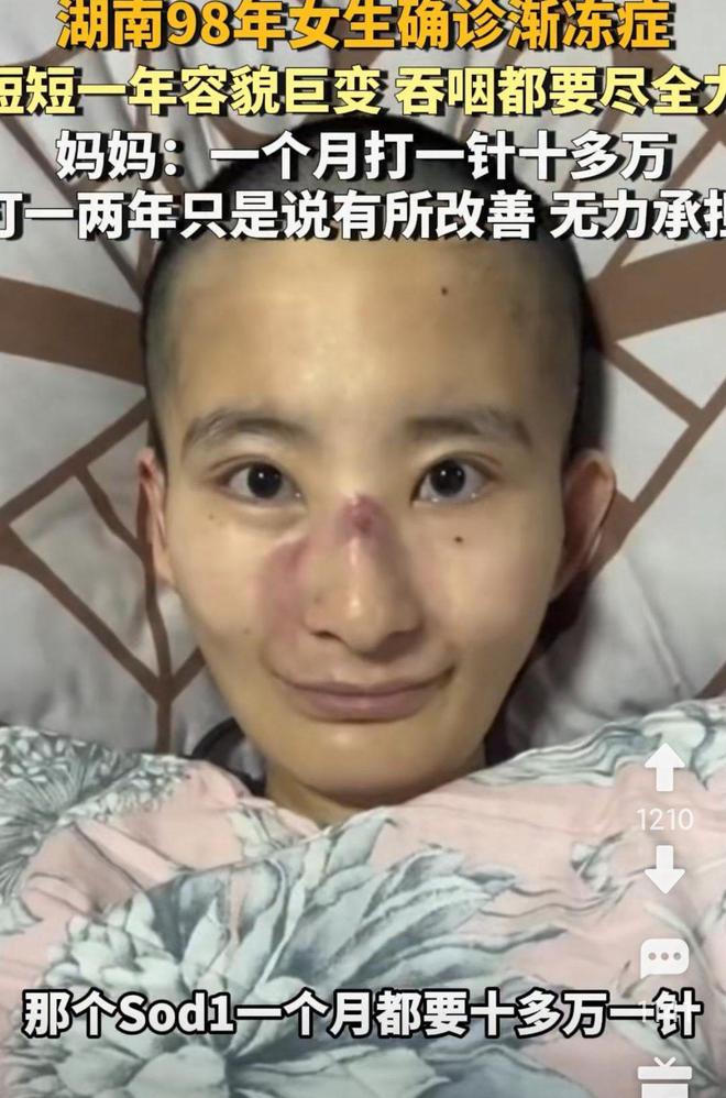 女生确诊渐冻症一年容貌巨变