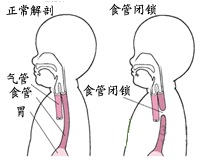 婴儿胃管反流的症状是什么样的