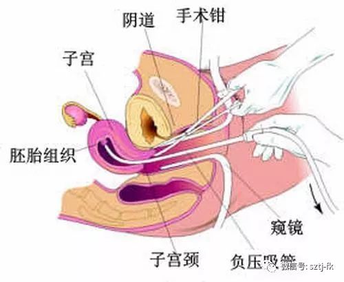 人流有痛和无痛价格